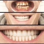 نتائج قبل وبعد طقم الأسنان الهجين All-on-6 في عيادة HALDENT، تحول الابتسامة