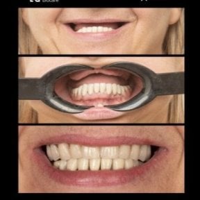 نتائج طقم الأسنان الهجين All-on-6 في HALDENT Dental Clinic – ابتسامة محسنة