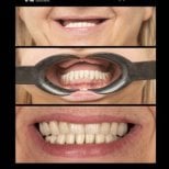 نتائج طقم الأسنان الهجين All-on-6 في HALDENT Dental Clinic – ابتسامة محسنة