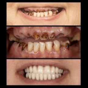 Before and after All-on-6 dental implants result at HALDENT Dental Clinic, smile restoration