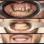 Результат до и после имплантации All-on-6 в HALDENT Dental Clinic, восстановление улыбки