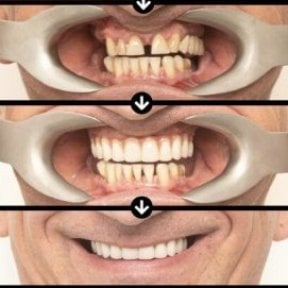Before and after All-on-4 dental implants results at HALDENT Dental Clinic, smile restoration