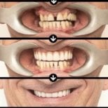 Before and after All-on-4 dental implants results at HALDENT Dental Clinic, smile restoration