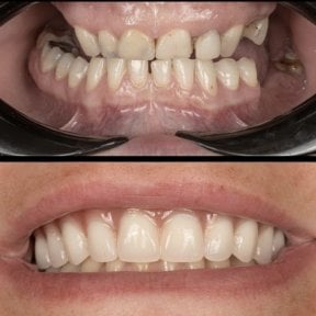 نتائج قبل وبعد طقم أسنان هجين All-on-6 في عيادة HALDENT Dental Clinic