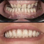 نتائج قبل وبعد طقم أسنان هجين All-on-6 في عيادة HALDENT Dental Clinic