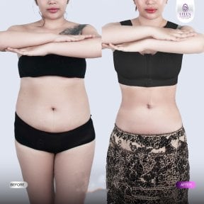Результаты до и после Vaser липосакции в Lelux Hospital – улучшение контура талии