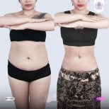 Результаты до и после Vaser липосакции в Lelux Hospital – улучшение контура талии