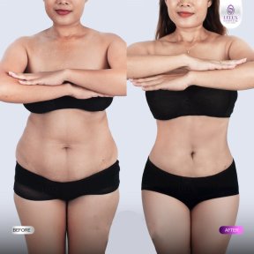 Результаты до и после Vaser-липосакции в Lelux Hospital – улучшение контуров тела
