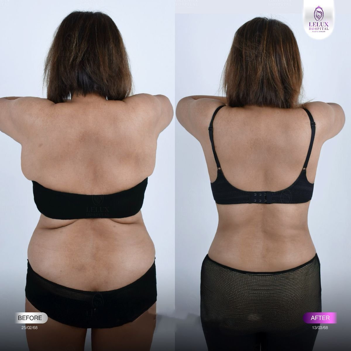 Resultados de Vaser liposucción antes y después en Lelux Hospital – contorno de espalda mejorado