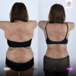 Результаты Vaser липосакции до и после в Lelux Hospital – улучшенный контур спины