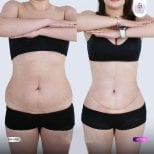 Результаты абдоминопластики до и после в Lelux Hospital – улучшение контура живота