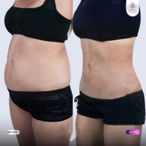 Результаты до и после Vaser липосакции в Lelux Hospital, видимое моделирование живота