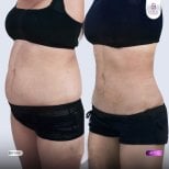 Результаты до и после Vaser липосакции в Lelux Hospital, видимое моделирование живота