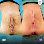 Résultats avant et après labiaplastie à Lelux Hospital – contour et symétrie améliorés