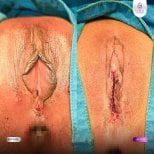 Результати до і після лабіопластики в Lelux Hospital – зменшення та корекція статевих губ