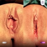 Résultats avant/après labiaplastie à Lelux Hospital – aspect amélioré des lèvres