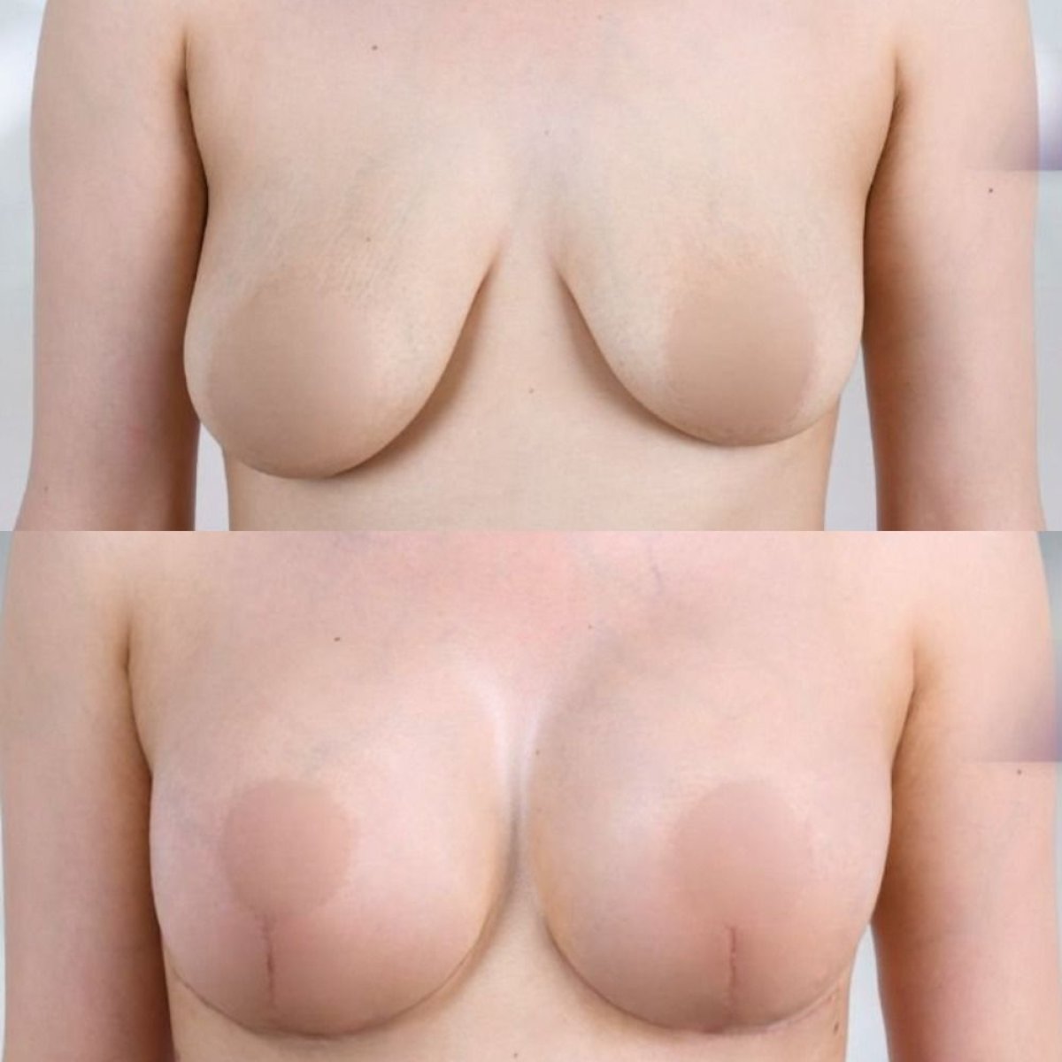Resultados antes y después de mastopexia con implantes redondos – mejor forma y volumen