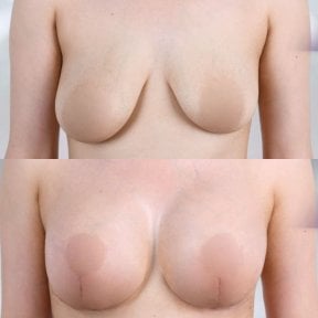 Результаты до и после подтяжки груди с круглыми имплантами – форма и объем улучшены