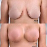 Результати до і після підтяжки грудей з круглими імплантами, покращена форма і об’єм