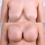 Результат до и после подтяжки груди с круглыми имплантами – улучшенная форма и объем