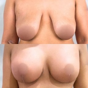 Результаты до и после подтяжки груди с круглыми имплантами, улучшена форма и объем