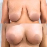 Результаты до и после подтяжки груди с круглыми имплантами, улучшена форма и объем