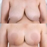 Результаты до и после подтяжки груди с круглыми имплантами, улучшена форма и объем