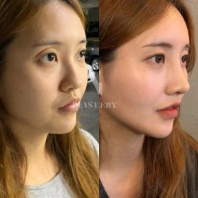 Результаты ринопластики до и после в VG Plastic Surgery, естественная форма носа