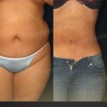 Before and after liposuction results at Memorial Bahçelievler Hospital, slimmer waist contour