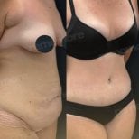 Before and after liposuction results at Memorial Bahçelievler Hospital, improved body contour