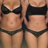 Before and after liposuction results at Memorial Bahçelievler Hospital, improved body contour
