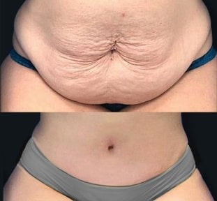 Before and after liposuction results at Memorial Bahçelievler Hospital, abdomen contouring