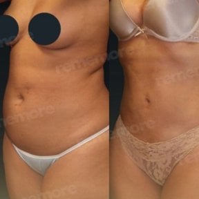 Before and after liposuction results at Memorial Bahçelievler Hospital, improved body contour