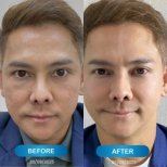 Résultats avant et après thérapie de rajeunissement par cellules souches au Harmony Life Center