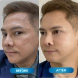 Résultats avant et après thérapie de rajeunissement par cellules souches au Harmony Life Center, peau lissée