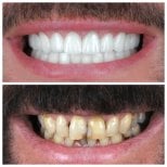 Résultats avant/après implants dentaires à YEG Clinic – sourire restauré et dents blanches