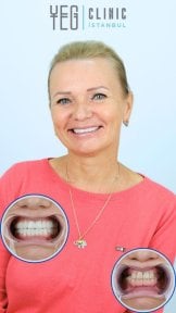 Résultats avant et après implants dentaires à YEG Clinic, sourire et dents restaurés