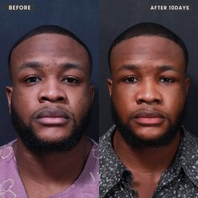 Результат підтяжки обличчя через 10 днів до і після у VG Plastic Surgery, омолодження