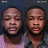 Результат підтяжки обличчя через 10 днів до і після у VG Plastic Surgery, омолодження