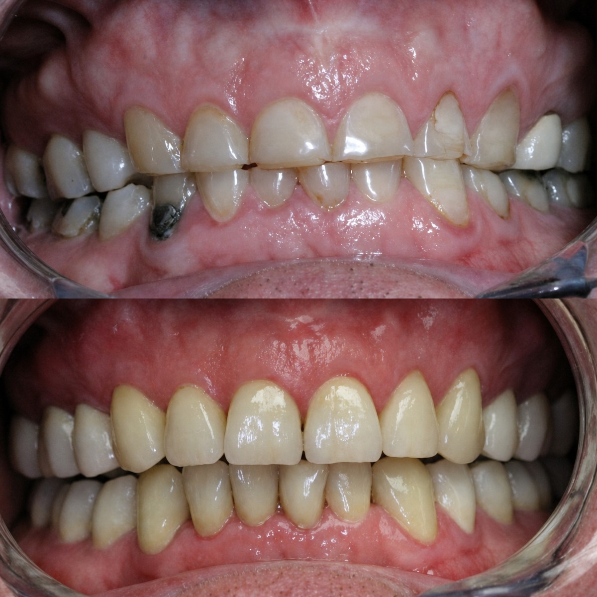 Resultados antes y después de restauración dental inlay/onlay – mejora en apariencia dental