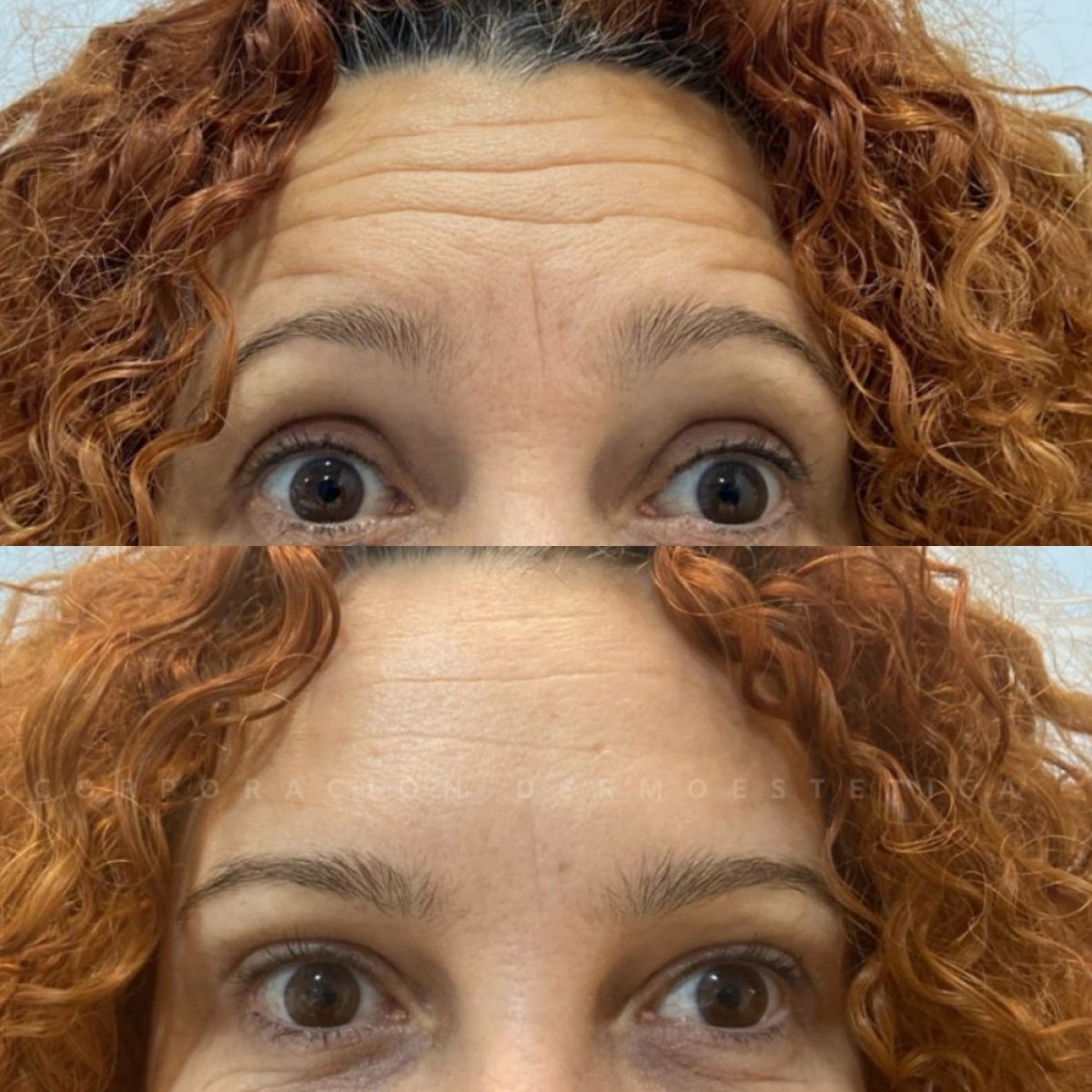 Resultados antes y después de botox para arrugas en la frente, alisado visible