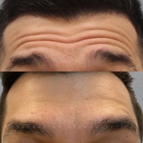 Vorher-nachher-Ergebnis von Botox-Stirninjektionen, sichtbare Glättung