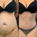 Before and after Vaser liposuction results at Memorial Şişli Hospital, abdomen contour improvement