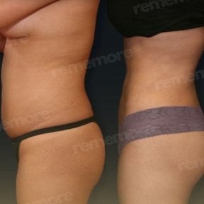 Before and after Vaser liposuction results at Memorial Şişli Hospital, improved body contour