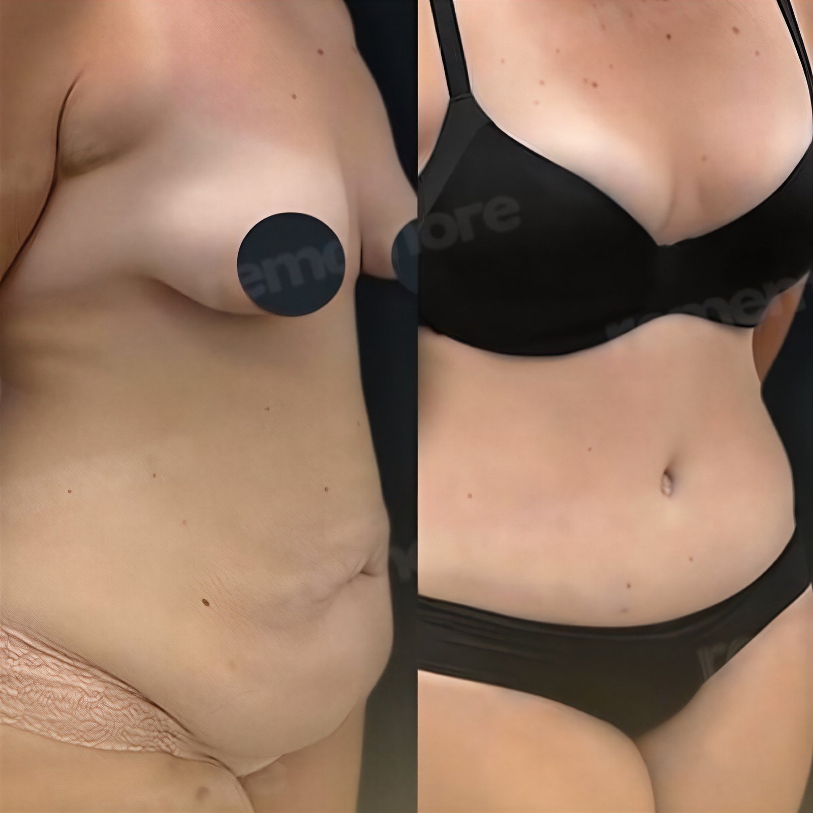 Resultados antes y después de liposucción Vaser en Memorial Şişli Hospital, mejora corporal