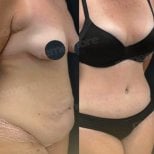 Before and after Vaser liposuction results at Memorial Şişli Hospital, body contour improvement