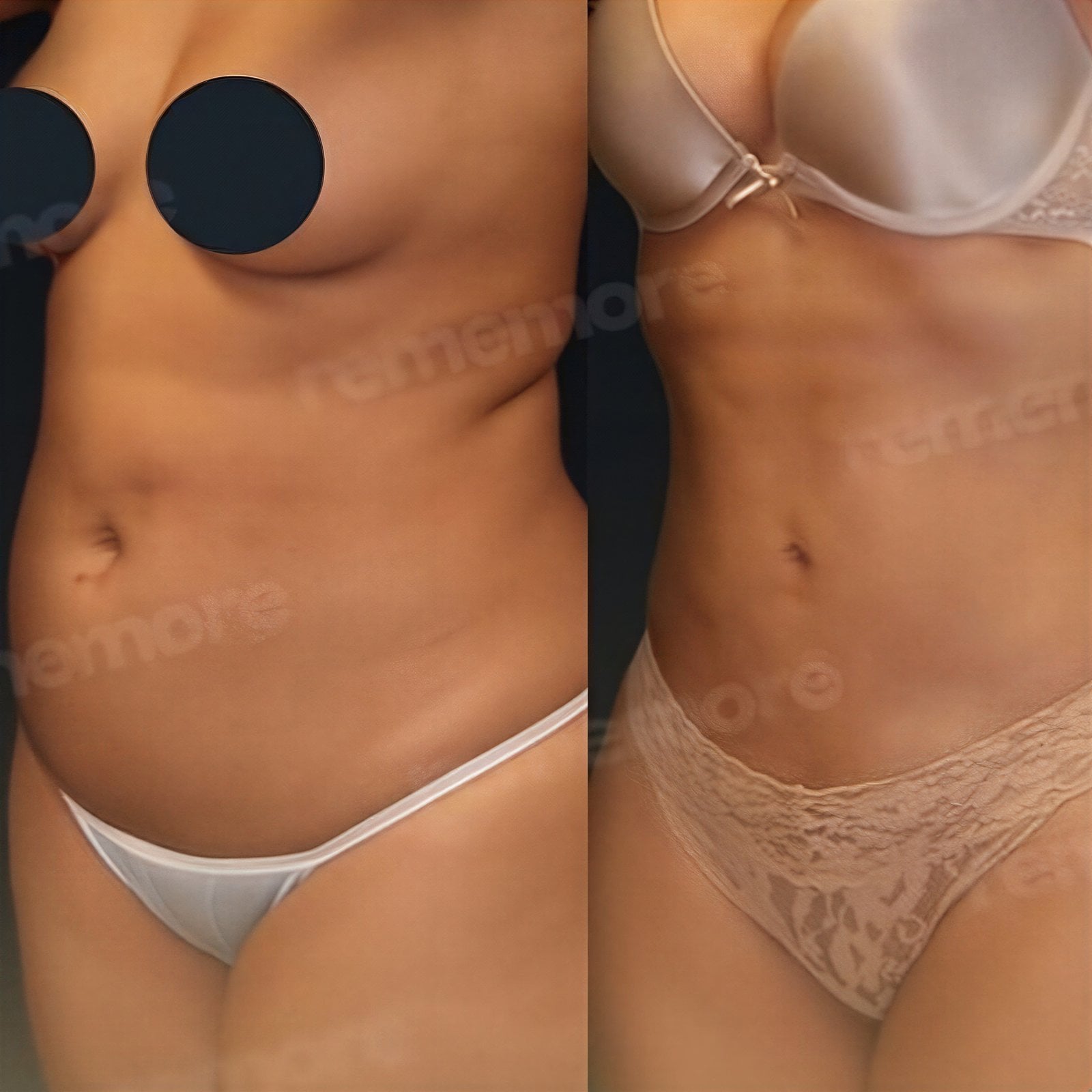 Resultados antes y después de liposucción Vaser en Memorial Şişli Hospital, contorno mejorado