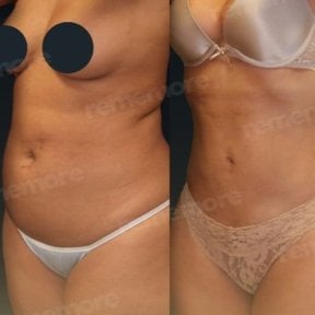Before and after Vaser liposuction results at Memorial Şişli Hospital, improved body contour
