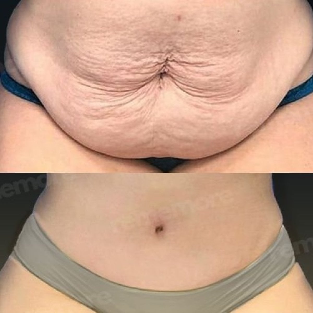 Resultados antes y después de liposucción Vaser en Memorial Şişli Hospital, abdomen mejorado