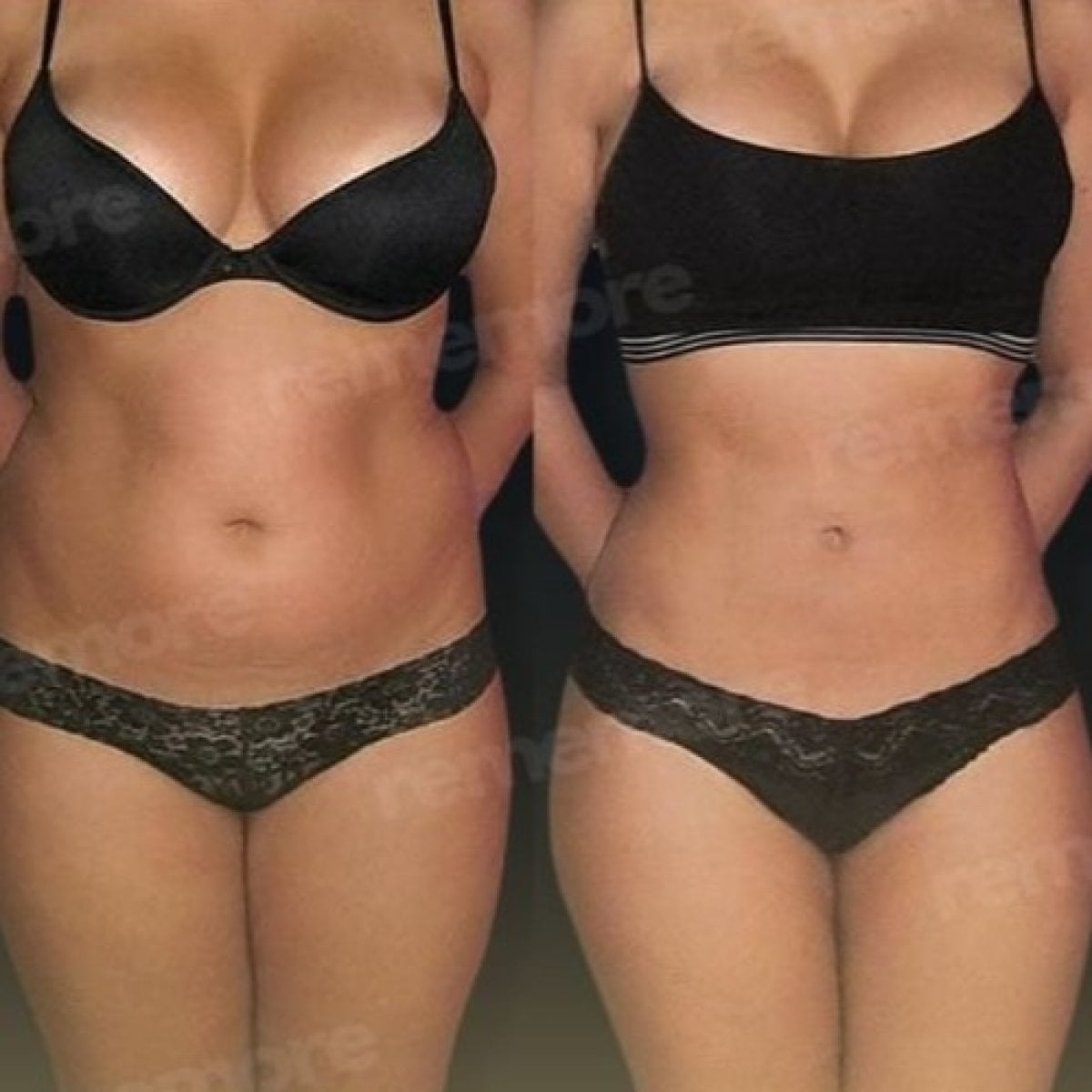 Resultados antes y después de liposucción Vaser en Memorial Şişli Hospital, mejor contorno corporal